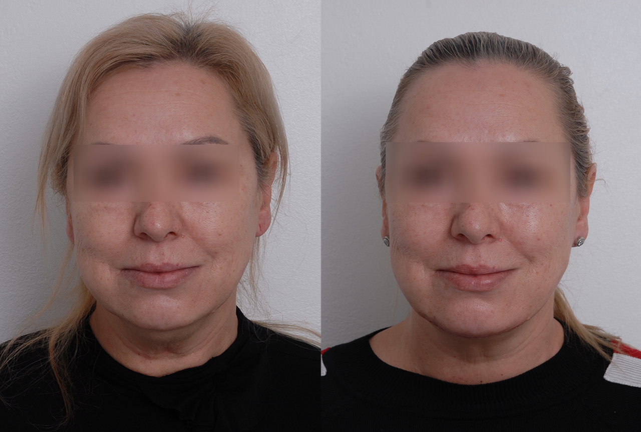 Chirurgické odstranění podbradku - foto před a po