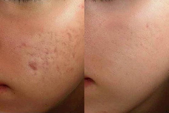 Photos Before and After Removal of  acne scars