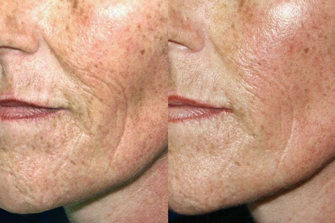 Hydro-lift – removal of wrinkles with Vital Injector