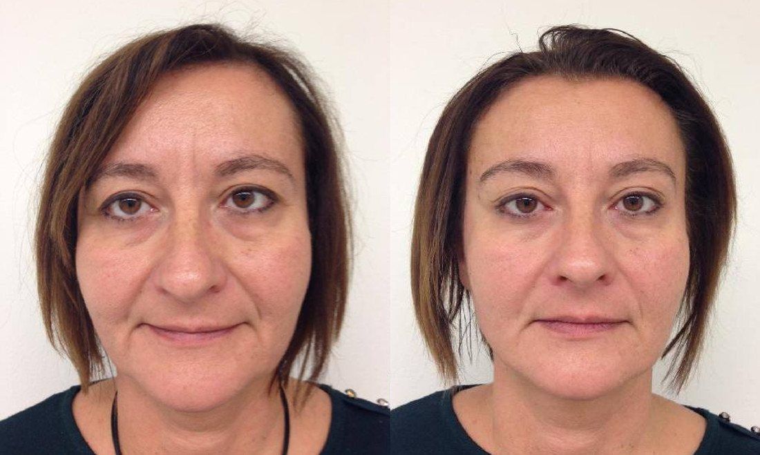 Face Mini lift Before and After procedure