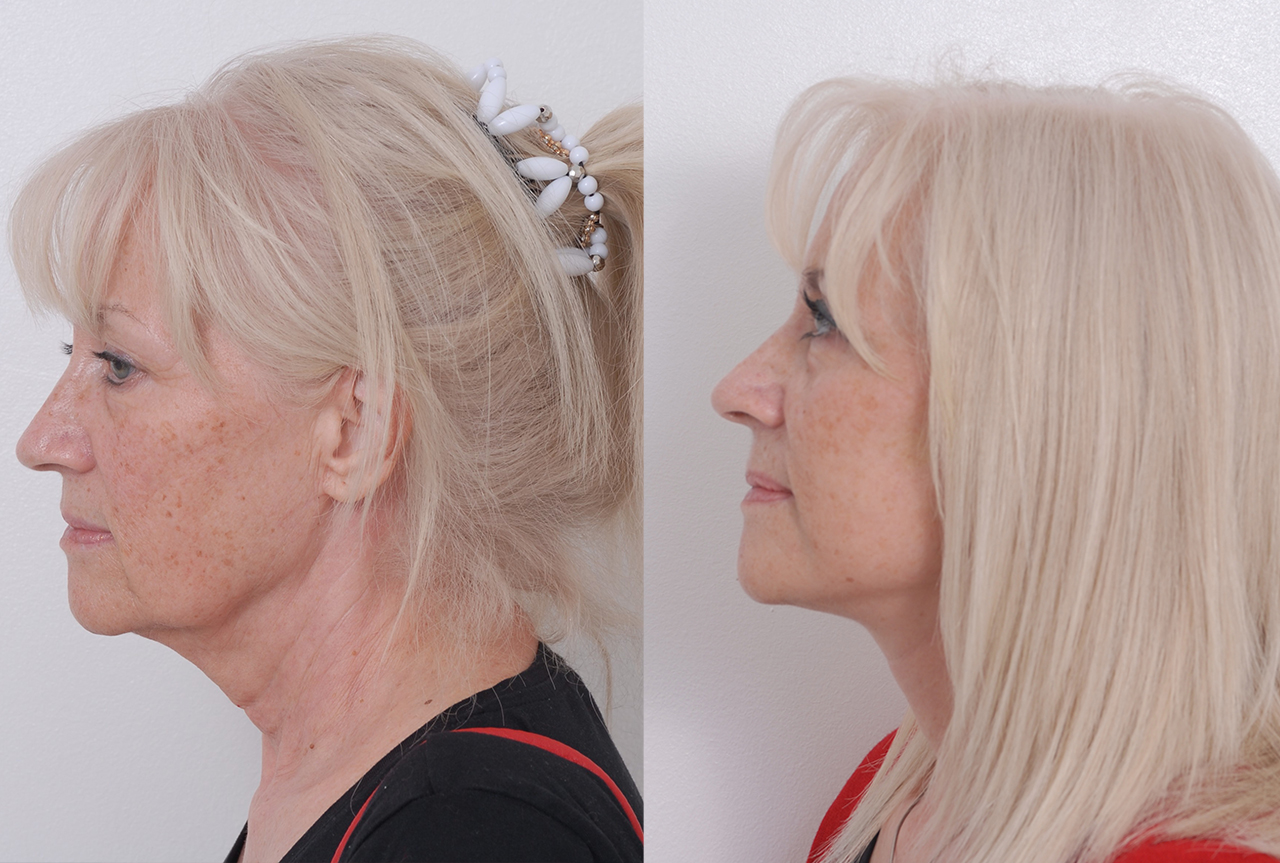 Facelifting Quick Lift - foto před a po