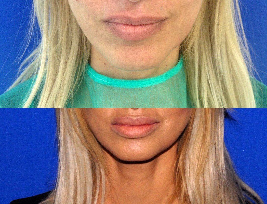 Enlargement of lips by Micro Seffi method